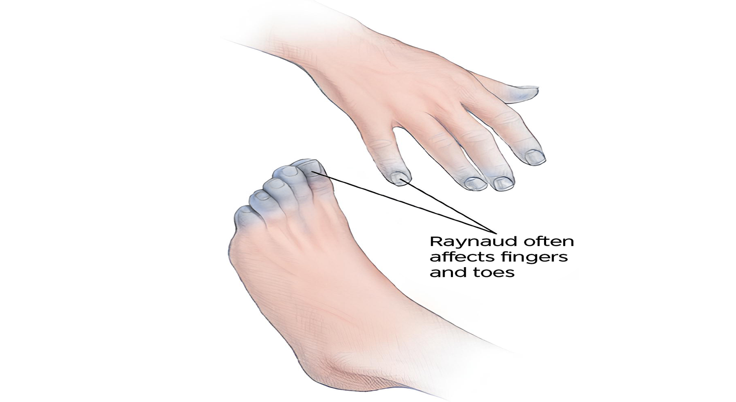 Raynaud’s Disease Treatment